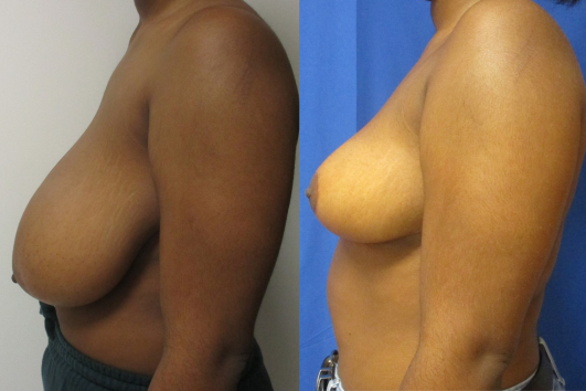 breast reduction before & after