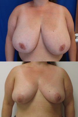 breast reduction before & after