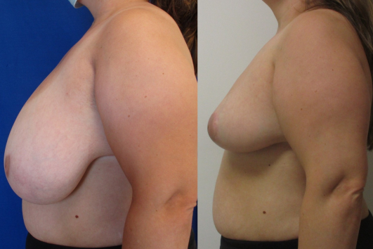 breast reduction before & after