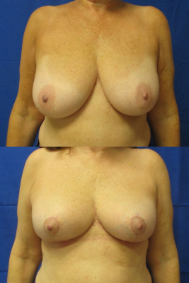 breast reduction before & after