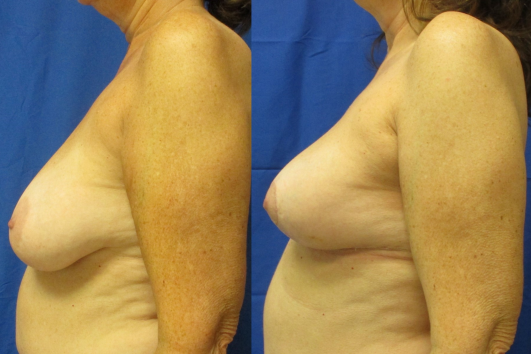 breast reduction before & after