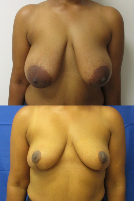breast reduction before & after