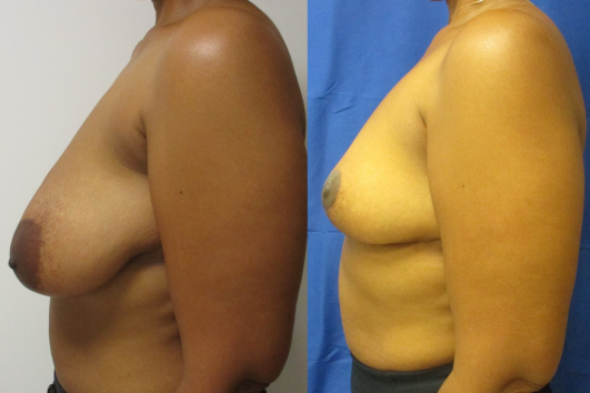 breast reduction before & after