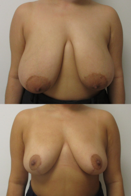 breast reduction before & after