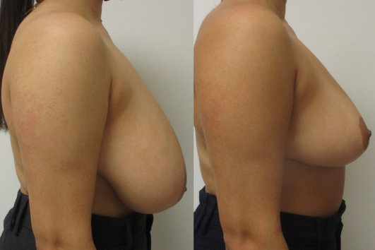 breast reduction before & after