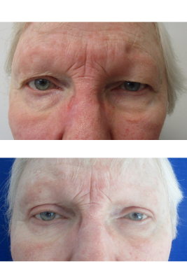 Bilateral Upper Eyelid Blepharoplasty before & after