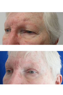 Bilateral Upper Eyelid Blepharoplasty before & after