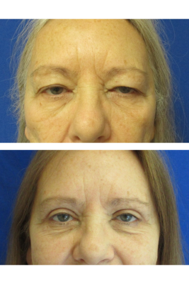 Bilateral Upper Eyelid Blepharoplasty before & after
