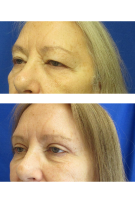 Bilateral Upper Eyelid Blepharoplasty before & after