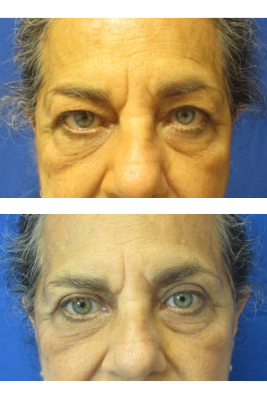 Bilateral Upper Eyelid Blepharoplasty before & after