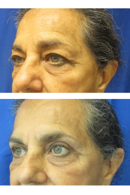 Bilateral Upper Eyelid Blepharoplasty before & after