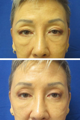 Bilateral Upper & Lower Eyelid Blepharoplasty before & after
