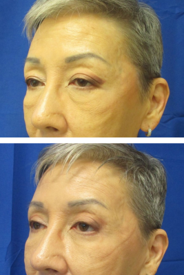 Bilateral Upper & Lower Eyelid Blepharoplasty before & after