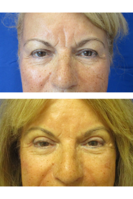 Bilateral Upper Eyelid Blepharoplasty before & after