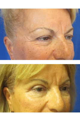 Bilateral Upper Eyelid Blepharoplasty before & after