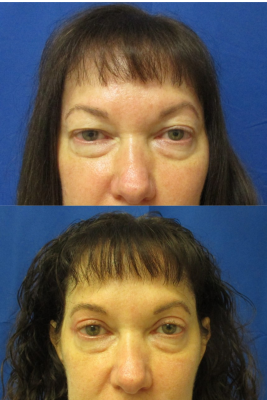 Bilateral Upper Eyelid Blepharoplasty before & after