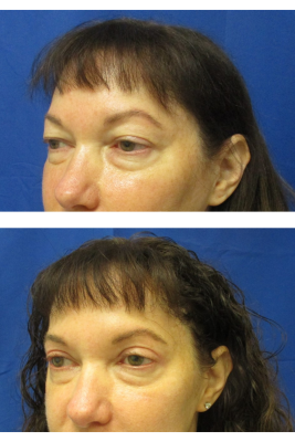 Bilateral Upper Eyelid Blepharoplasty before & after