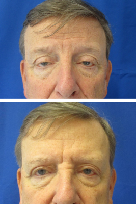 Bilateral Upper Blepharoplasty with Bilateral Ptosis Repair before & after