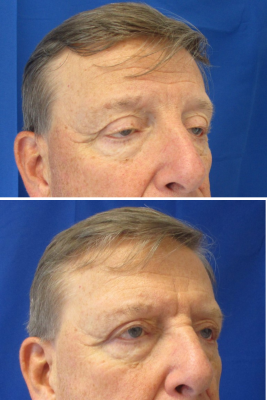 Bilateral Upper Blepharoplasty with Bilateral Ptosis Repair before & after