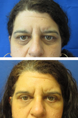 Bilateral Upper & Lower Eyelid Blepharoplasty before & after