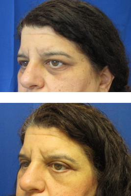 Bilateral Upper & Lower Eyelid Blepharoplasty before & after