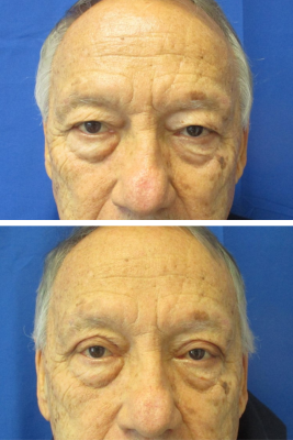 Bilateral Upper Eyelid Blepharoplasty before & after