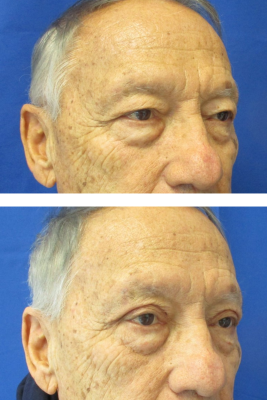 Bilateral Upper Eyelid Blepharoplasty before & after