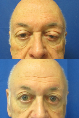 Bilateral Upper Eyelid Ptosis Repair before & after