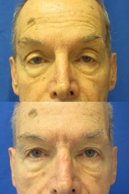Bilateral Upper Eyelid Ptosis Repair before & after