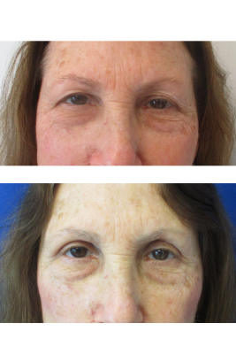 Bilateral Upper Eyelid Blepharoplasty before & after