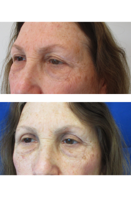 Bilateral Upper Eyelid Blepharoplasty before & after