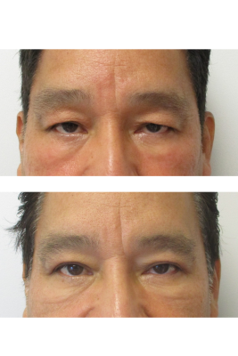 Bilateral Upper Eyelid Blepharoplasty before & after