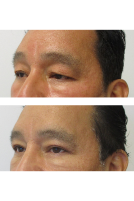 Bilateral Upper Eyelid Blepharoplasty before & after
