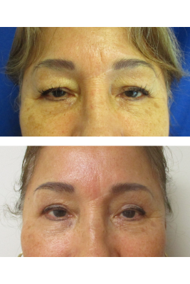 Bilateral Upper Eyelid Blepharoplasty before & after