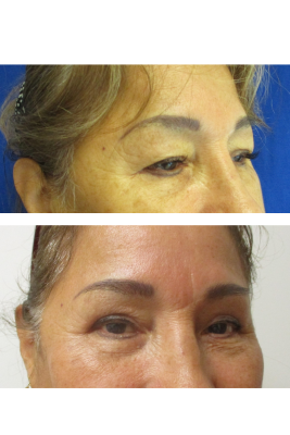Bilateral Upper Eyelid Blepharoplasty before & after
