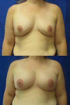 Breast augmentation before & after