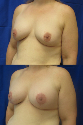 Breast augmentation before & after