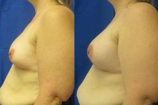 Breast augmentation before & after