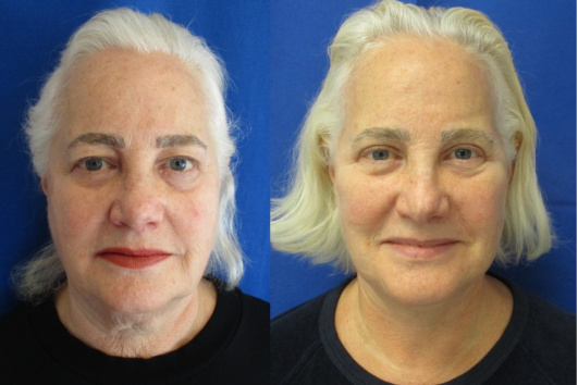 Facelift, Necklift with Bilateral Upper Bleph before & after