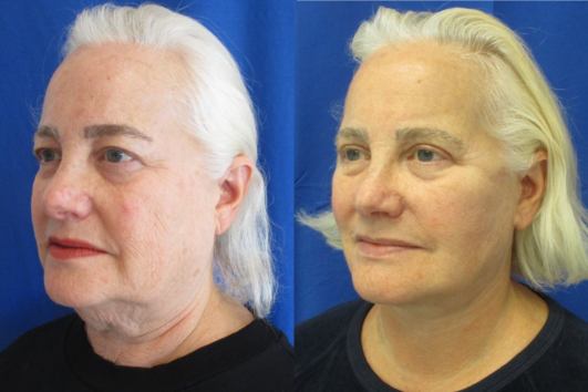 Facelift, Necklift with Bilateral Upper Bleph before & after