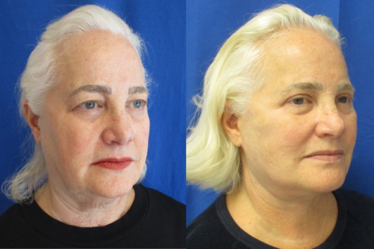 Facelift, Necklift with Bilateral Upper Bleph before & after