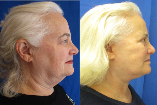 Facelift, Necklift with Bilateral Upper Bleph before & after