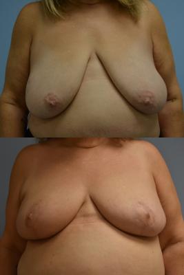 ONCOPLASTIC BREAST REDUCTION