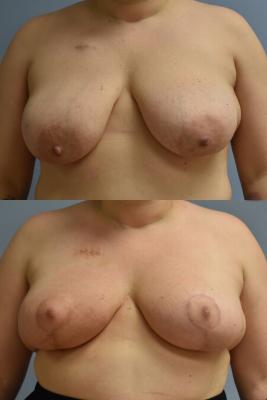 ONCOPLASTIC BREAST REDUCTION