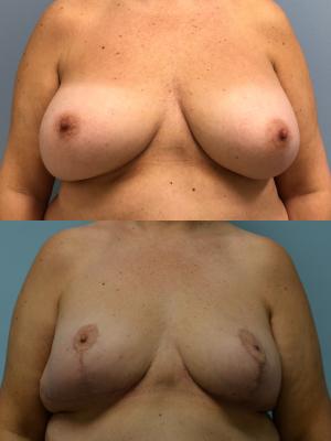 BREAST LIFT AND REMOVAL OF IMPLANTS 
