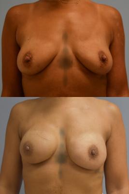 BREAST RECONSTRUCTION WITH TISSUE EXPANDERS