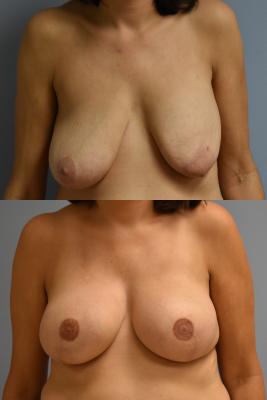 BREAST RECONSTRUCTION WITH TISSUE EXPANDERS