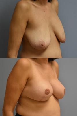 BREAST RECONSTRUCTION WITH TISSUE EXPANDERS