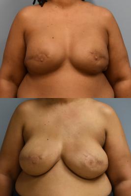 BREAST RECONSTRUCTION REVISION