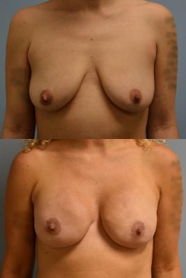 BREAST RECONSTRUCTION WITH TISSUE EXPANDER